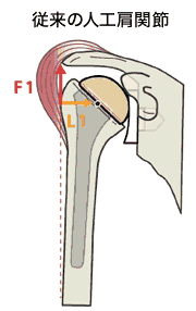 新技術のリバース型人工肩関節置換術（Reverse Shoulder Arthroplasty