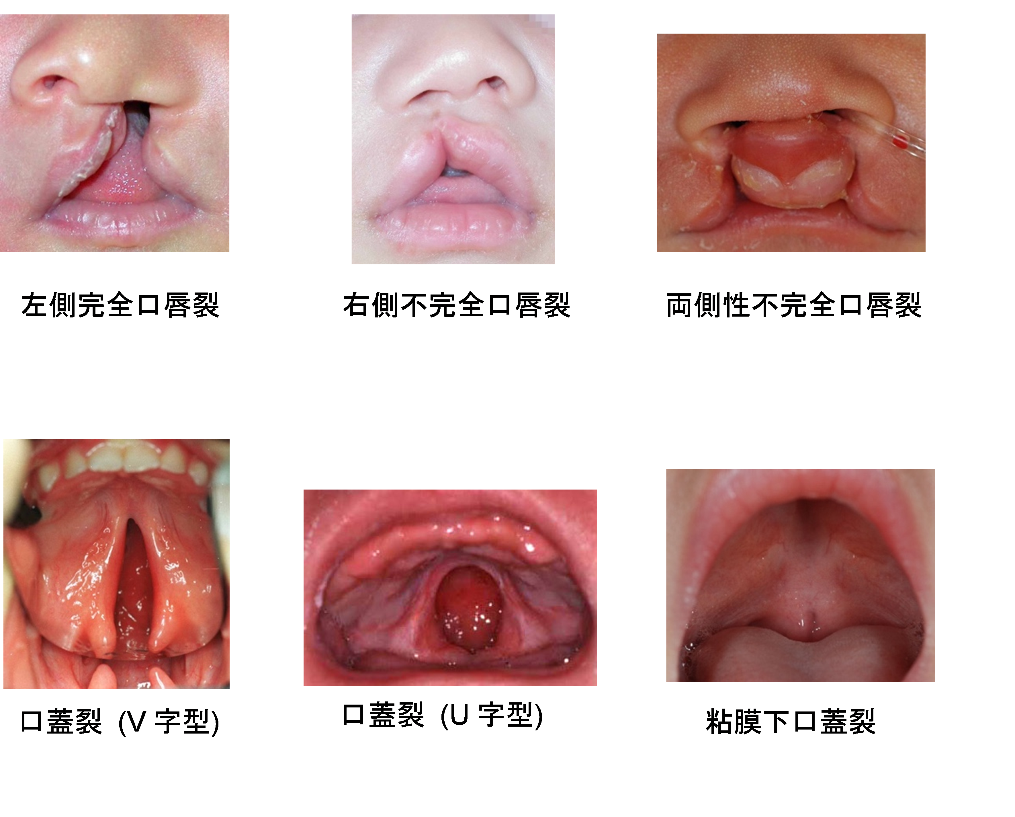 口唇口蓋裂外来 | 山口大学 歯科口腔外科