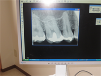 デジタルレントゲンについて - はせがわ歯科｜岡山県 笠岡市 歯科