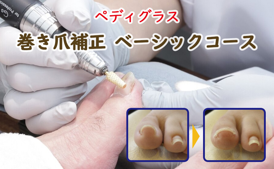 巻き爪補正ベーシックコース | 大田区西蒲田 たか整骨院
