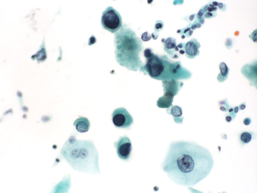 第13回 スライドカンファレンス症例 ｜ 泌尿器細胞診(別府)カンファレンス