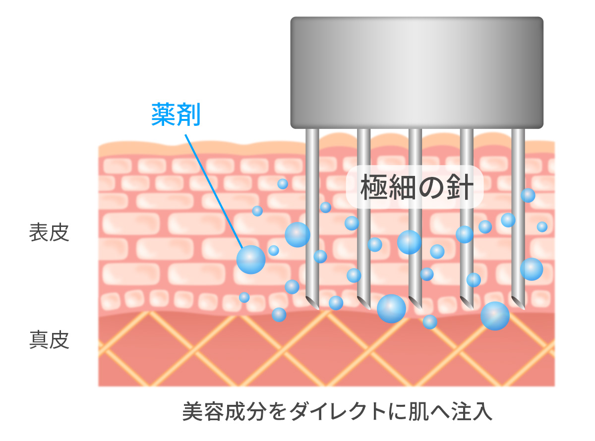 肌育注射｜Wi Clinic(ウィクリニック)【公式】 吉祥寺 水光注射