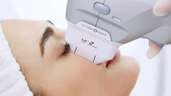 HIFU治療（高密度焦点式超音波）ウルトラフォーマーIII｜赤坂スキン