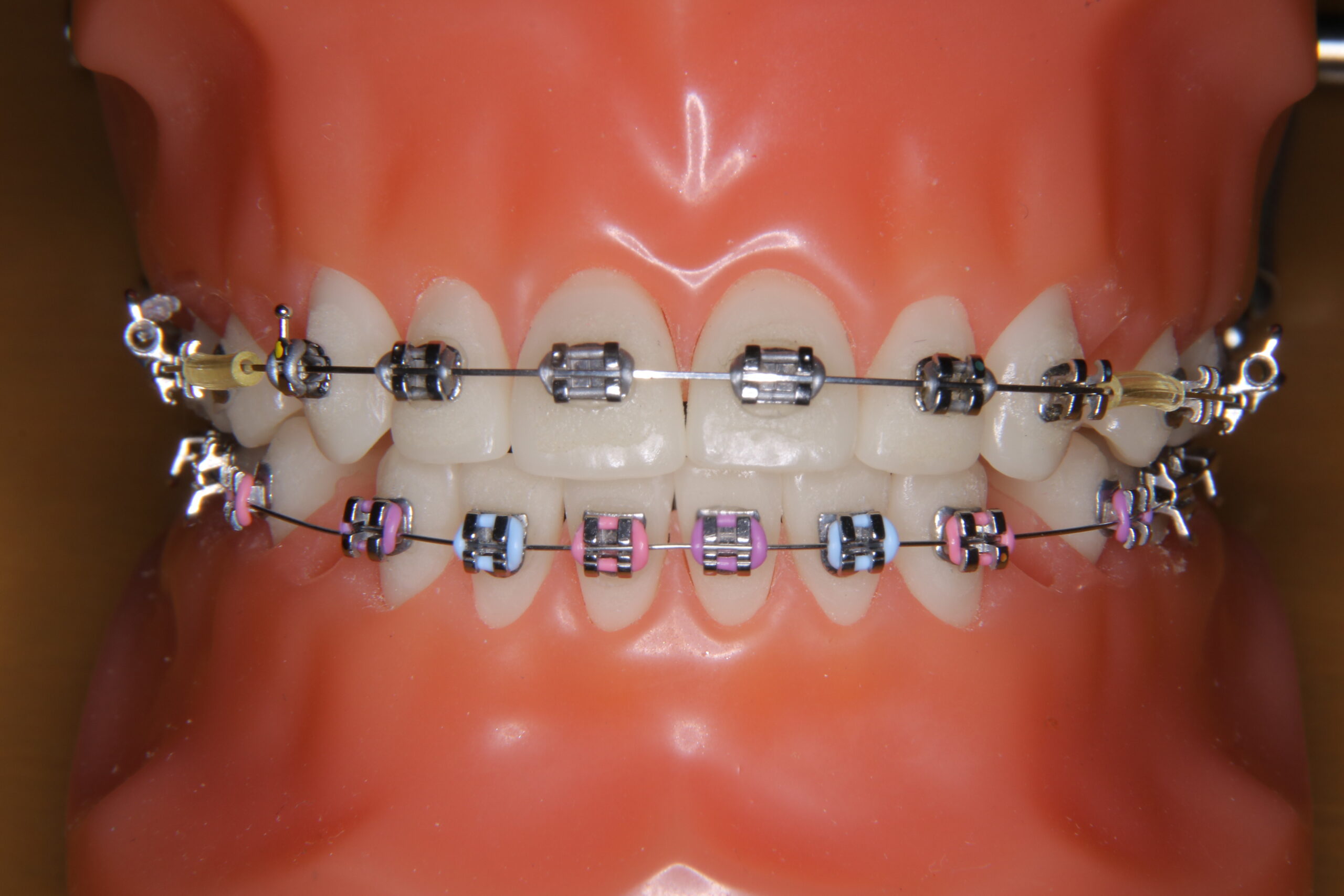 ブラケットの種類 - あかつき矯正歯科クリニック