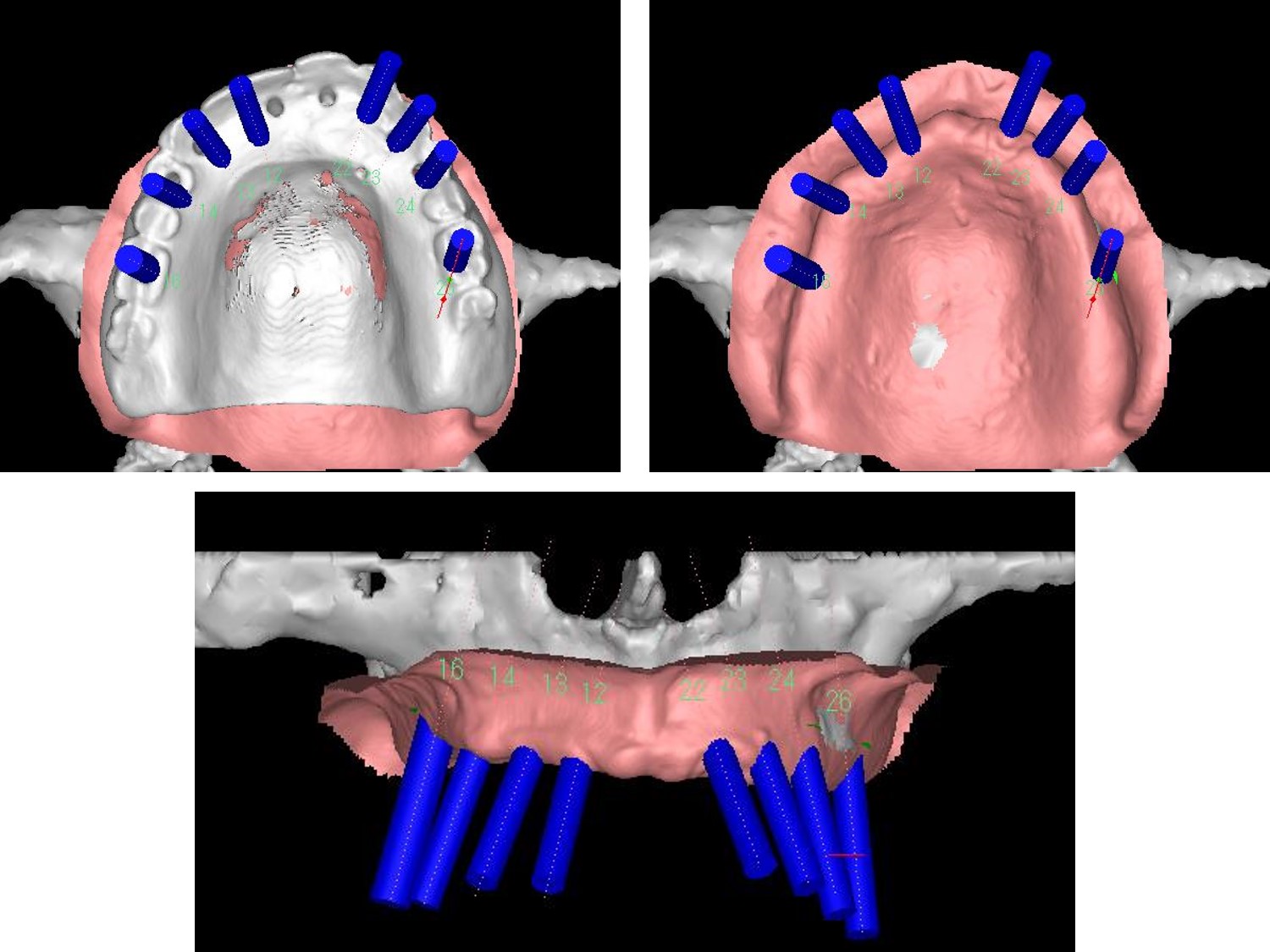 上顎無歯顎のインプラント症例解説ケース01｜上顎全欠損症例上顎無歯顎