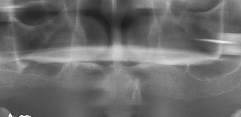 上顎無歯顎のインプラント症例解説ケース01｜上顎全欠損症例上顎無歯顎