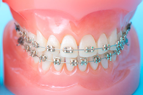 矯正装置の種類｜駅徒歩5分 川崎の矯正専門歯科「いしかわ矯正歯科」