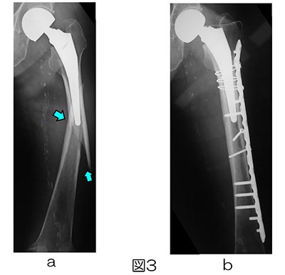 人工関節周囲骨折｜一般社団法人 日本整形外傷学会 骨折の解説