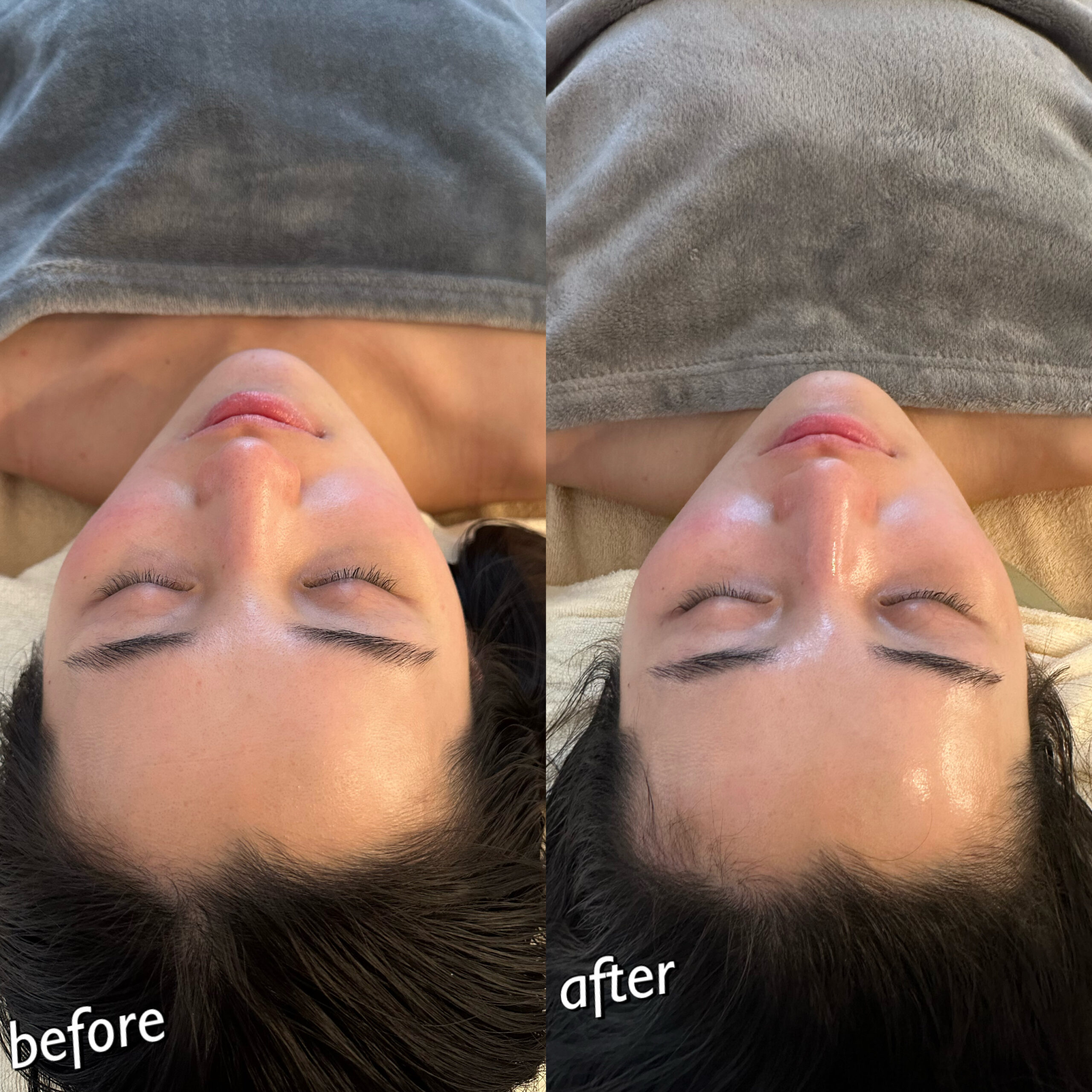 今、最も新しい話題の非接触型マシーン〜水光注射！ - LA BEL