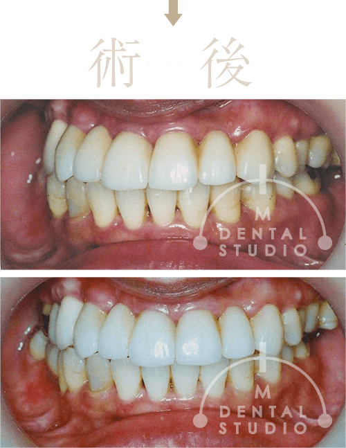 重度】30代女性「歯がボロボロ」インプラント10本以上必要と診断された