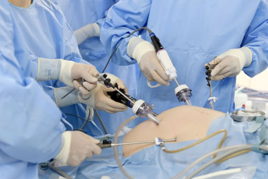 腹腔鏡下（ふくくうきょうか）手術について | 国立がん研究センター 東病院