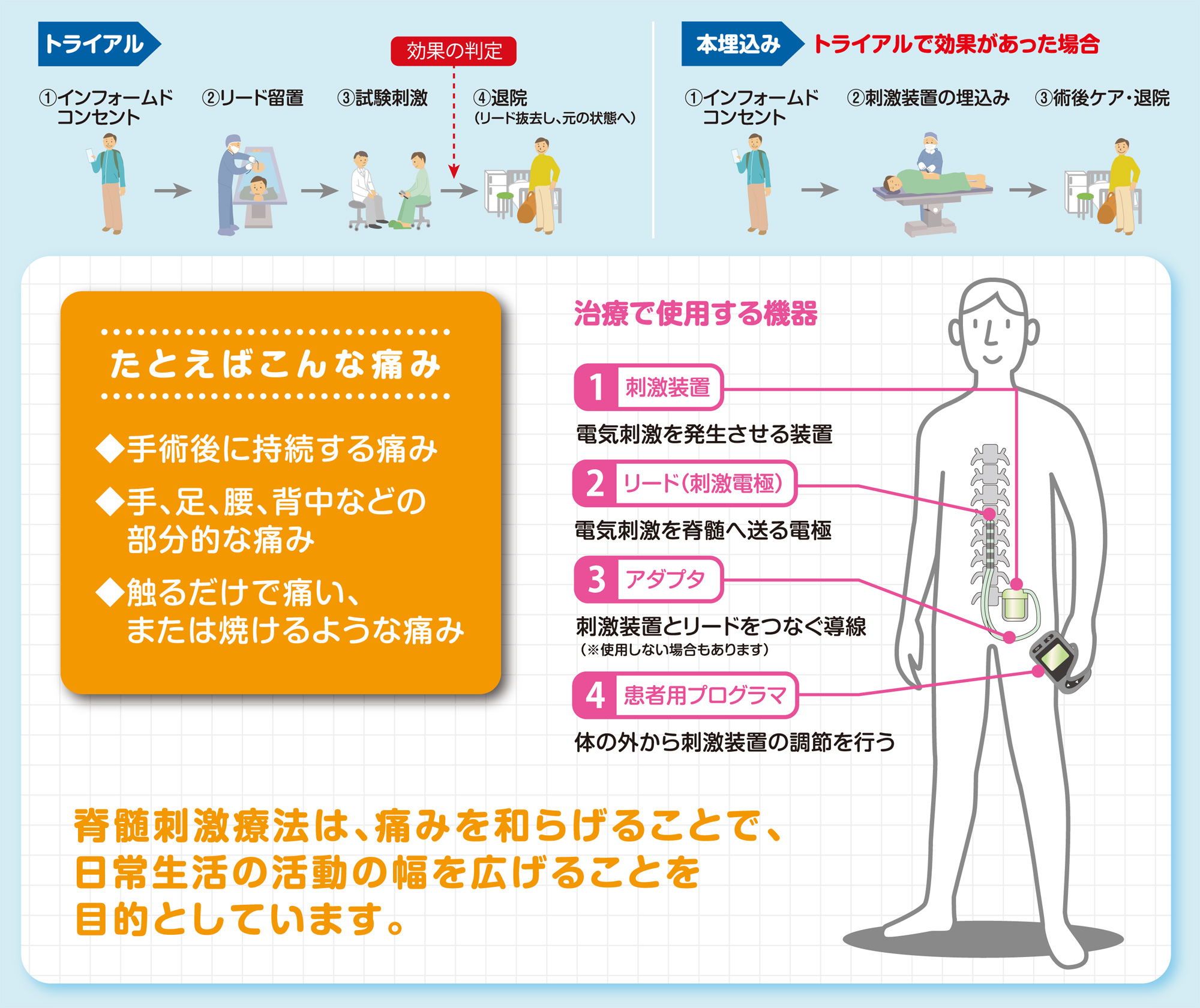 脊髄刺激療法（SCS）