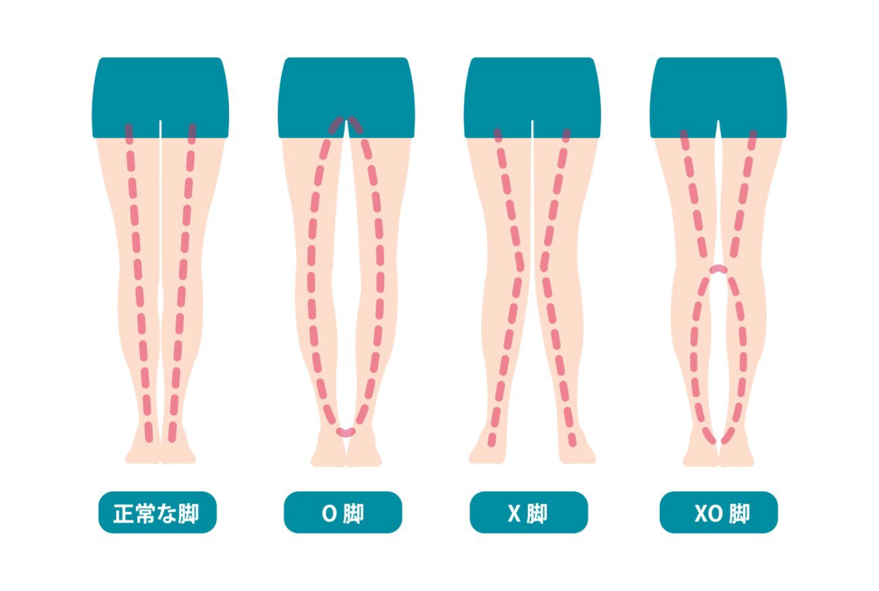O脚・X脚治療プログラム-痛みの原因治療専門外来【細野クリニック