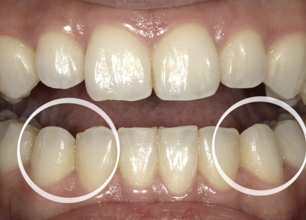 前歯のギザギザを治すには？ 歯の形を直す前歯形態修正（ティース