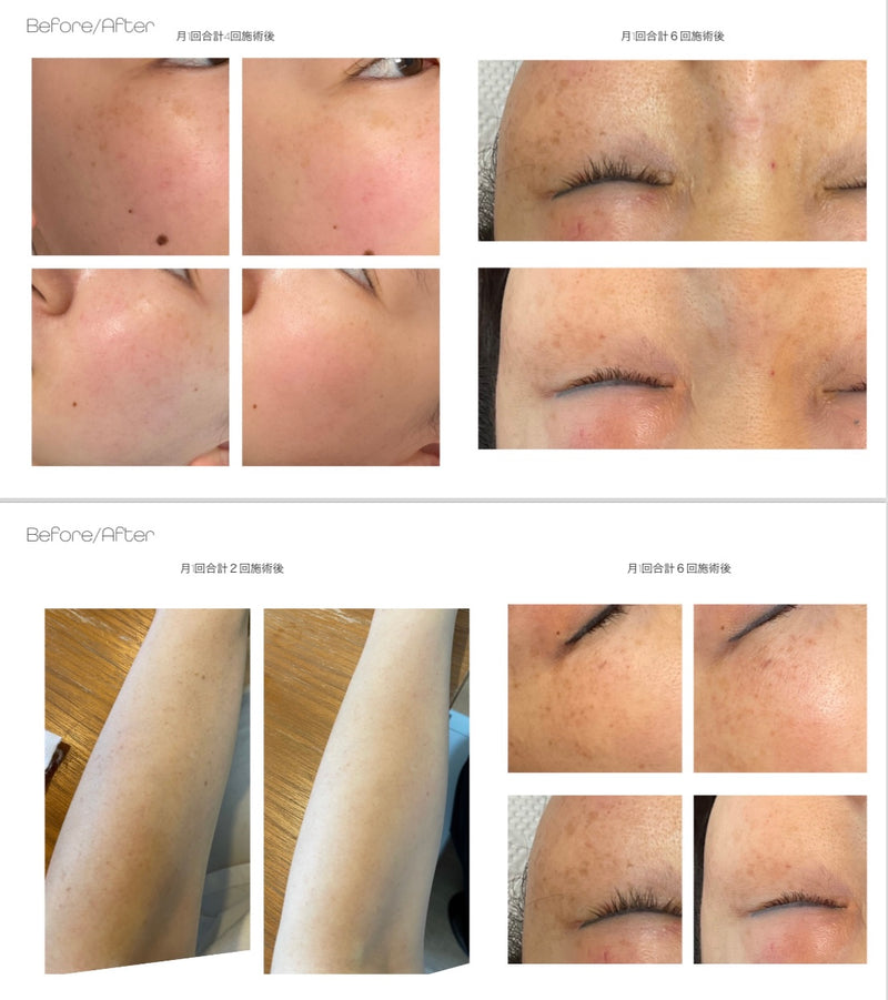 大好評！初回生産完売につき増産！！【国産】低周波シミケアペンPigwii