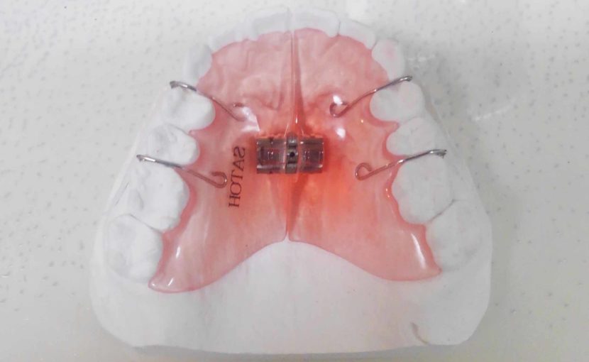 床矯正の矯正歯科治療でどこまで治るのか？ | 医療法人社団 FACE AND