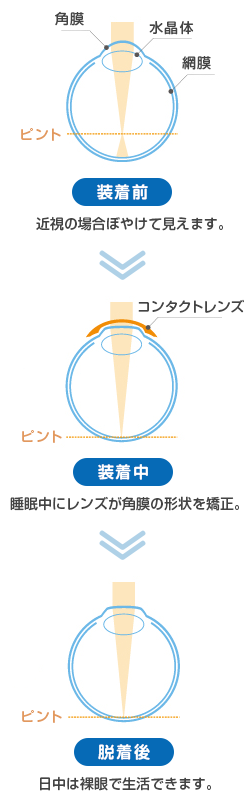 オルソケラトロジー | 手術・治療について | はやし眼科クリニック