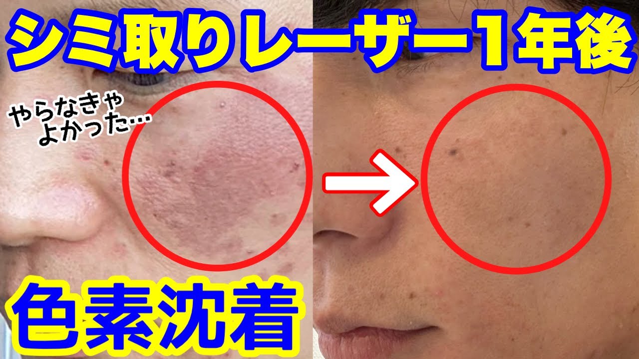 シミ取り】シミ取りレーザーした1年後 - YouTube