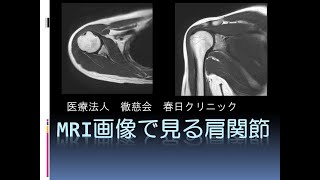 春日クリニック】MRI画像で見る肩関節 - YouTube