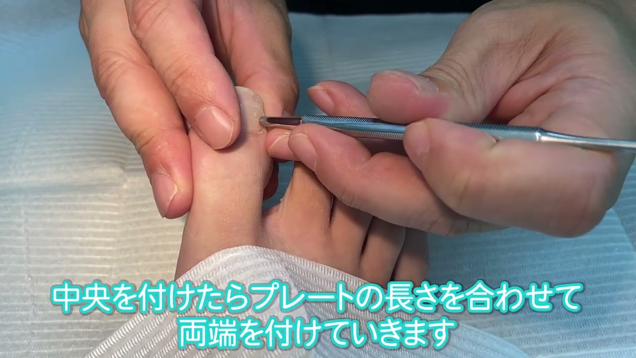 施術の流れ | 巻き爪矯正するなら巻き爪サロンLibreへ