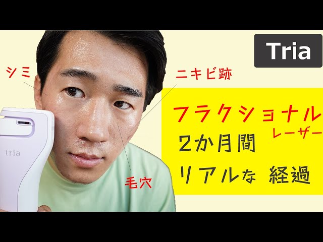 Tria Fractional Laser: Progress and Real Beauty Results After 2