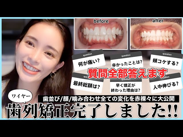 34歳】大人の歯列矯正でブラオフした3児母が気になること全て話して