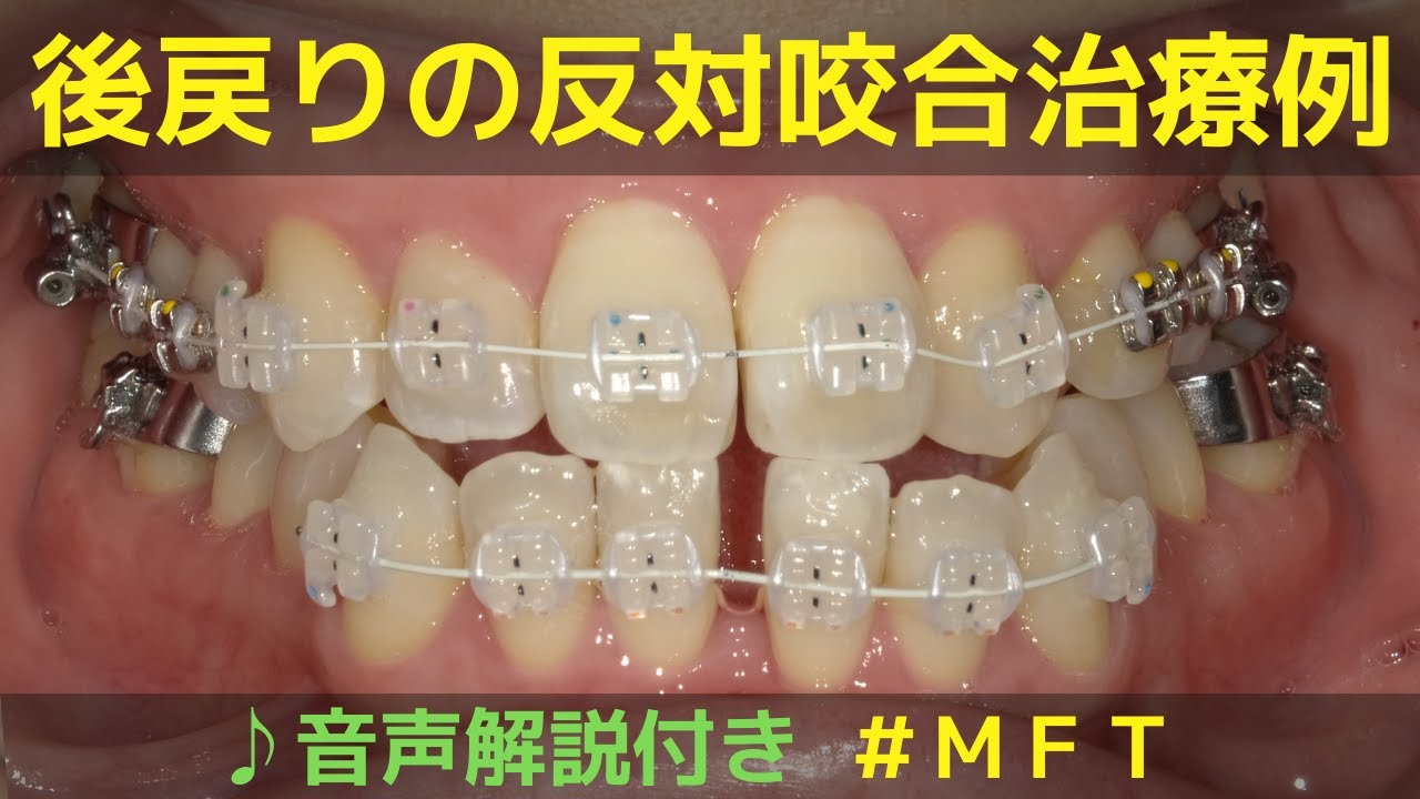 矯正・後戻りの再治療】MFTを併用した反対咬合抜歯矯正の治療例