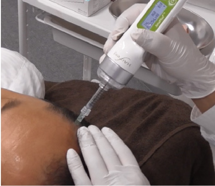 毛髪用注入剤｜AGAメソセラピーは大阪AGA加藤クリニック