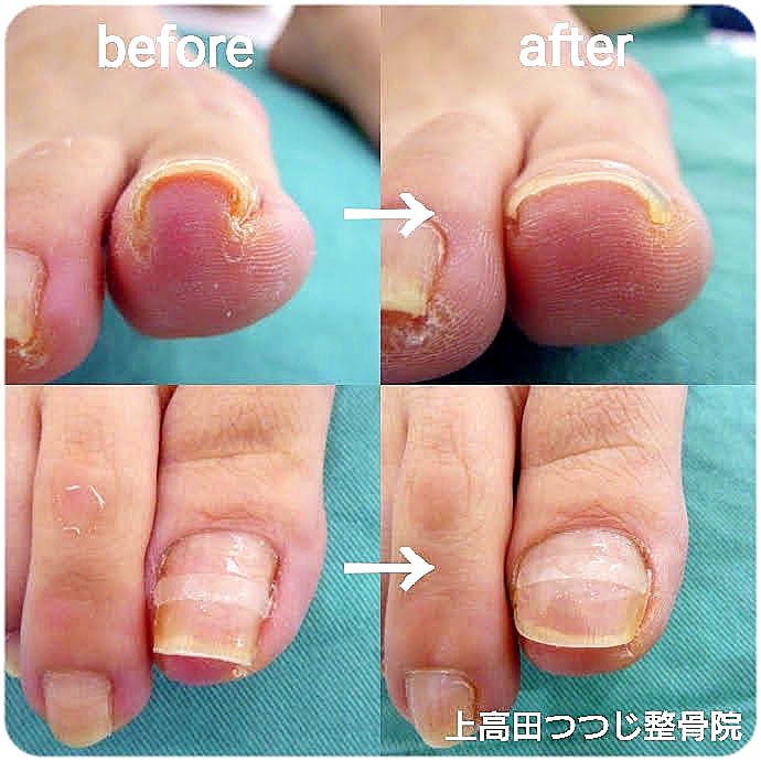 巻き爪ケア「B/Sスパンゲ」|中野区上高田の「上高田つつじ整骨院」