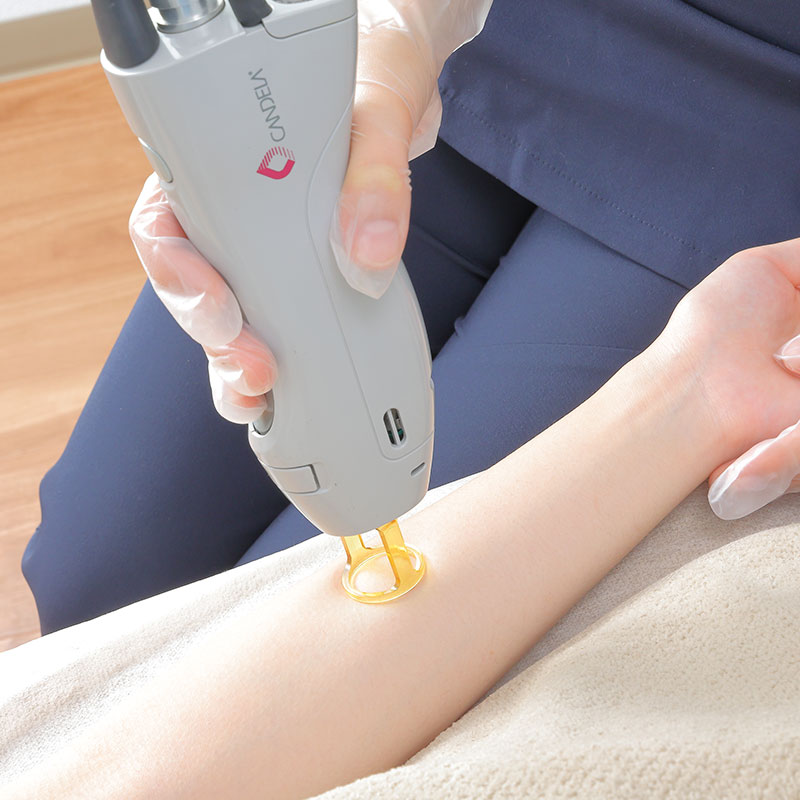 熱破壊式医療脱毛ならルシアクリニック