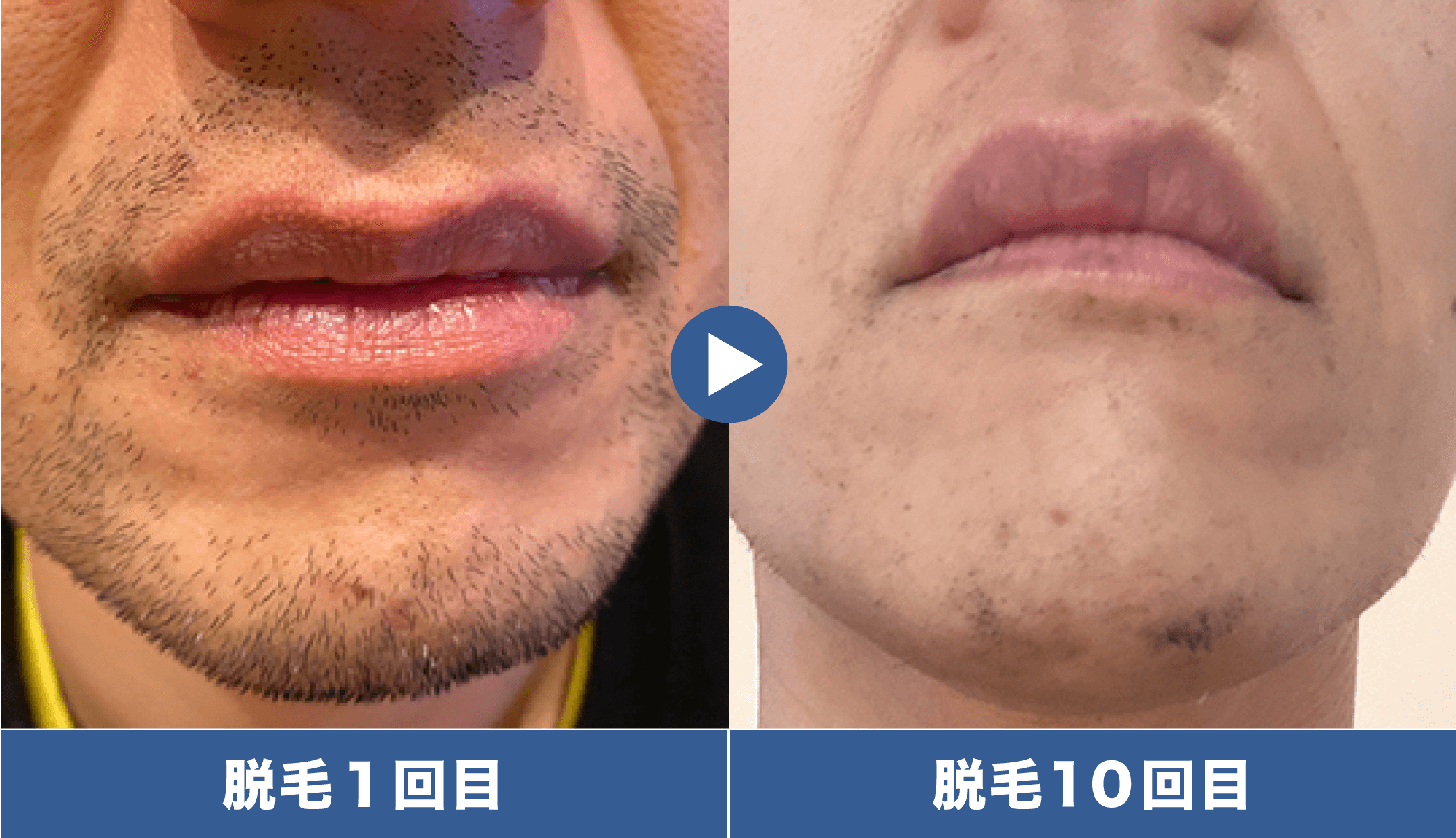 髭・顔脱毛の料金プラン｜ミュゼプラチナム｜メンズ脱毛・ヒゲ脱毛