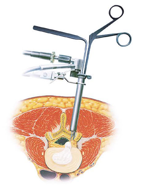 内視鏡下椎間板摘出術 ｜ 成尾整形外科病院
