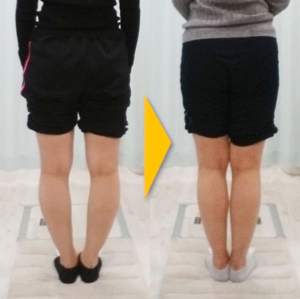 O脚と脚痩せ｜大阪のO脚矯正『整体院 そるん』