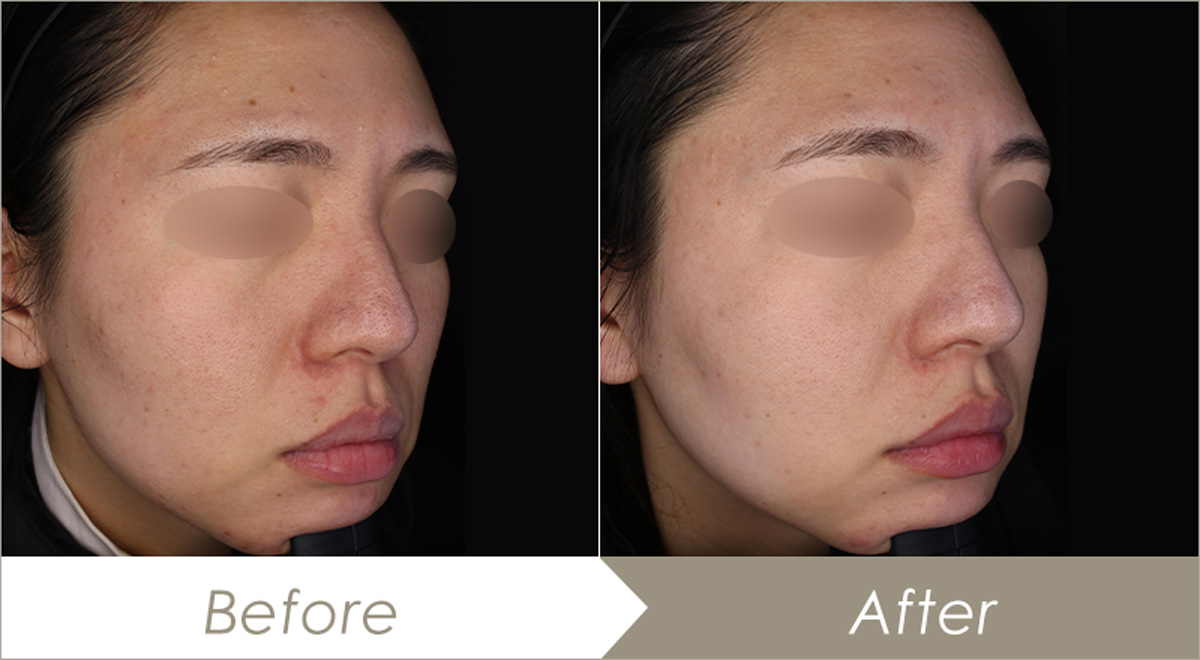 水光注射（ダーマシャインプロ）｜大阪のPSC