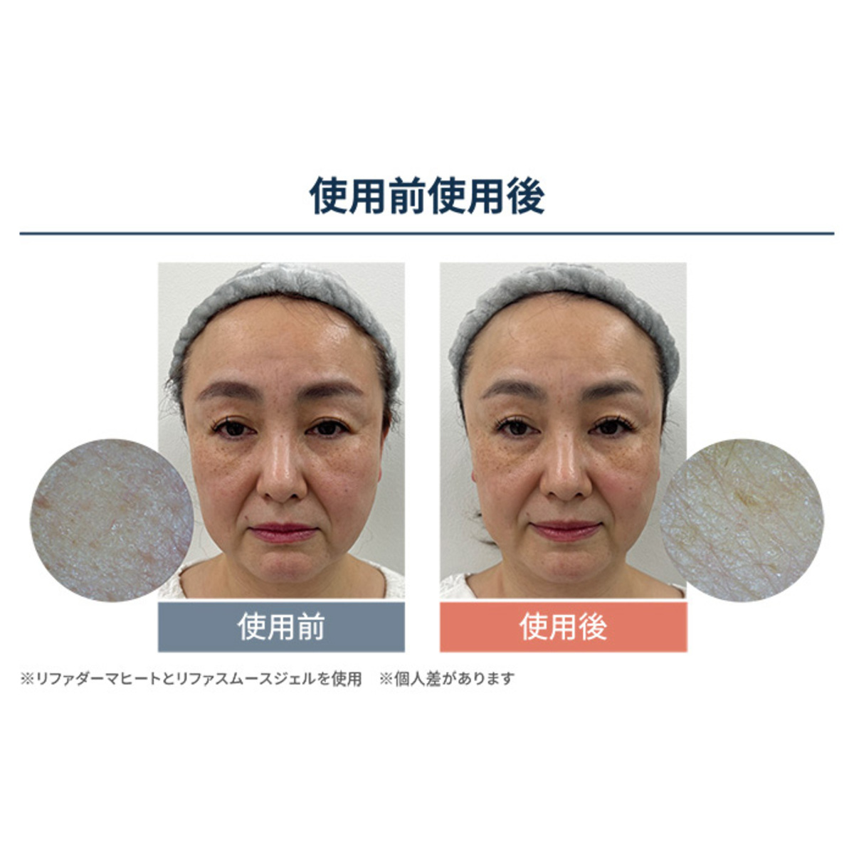 ReFa DERMA HEAT 特別セット リファ（ReFa） - QVC.jp