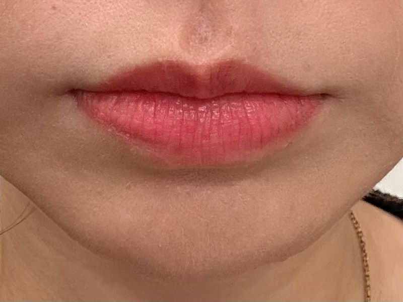 ローマピンク唇｜施術1回でここまで変化！実際の症例をご紹介