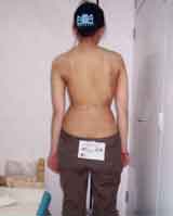 側湾症 【大塚整体治療院】 そくわん症 側わん症 側弯症